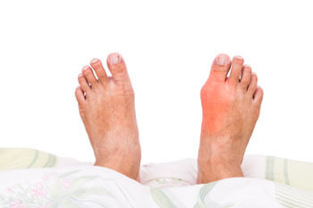 Minimally Invasive Bunion Treatment in the Toms River, NJ 08757 area